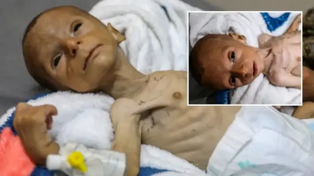 yetersiz beslenme nedeniyle gazzede 2 aylik bebegin yasami tehdit altinda YhDuJBx9